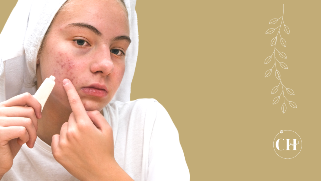 Cicatrizes de Acne: Você conhece os sintomas, riscos e cuidados básicos?