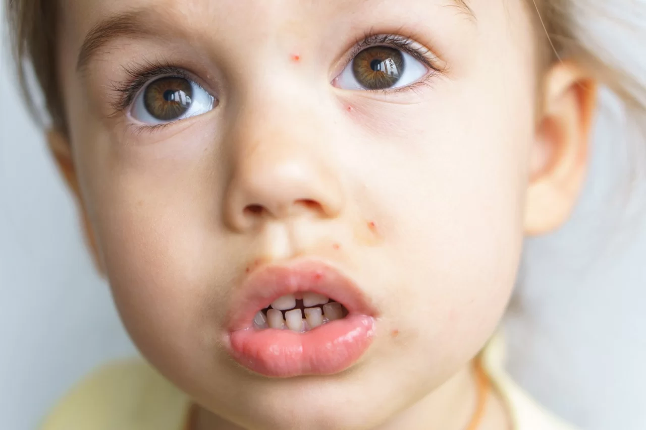 Molusco Contagioso